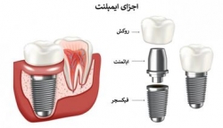 معرفی دکتر لمینت دندان و دکتر ایمپلنت دندان در یوسف آباد تهران | مجله سلامت و دانلود مداحی