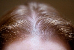 دلایل ریزش مو در زنان - چرا موی خانم‌ها نازک می‌شود؟ | مجله سلامت و دانلود مداحی